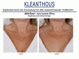 SkinTone sono beauty lifting, Eine Verjüngungskur von Dr. KLEANTHOUS für die Haut. Ob es sich nun um Falten, Tränensäcke, erschlafftes Gewebe oder auch Haarausfall handelt, cell supporting molecules (c.s.m.) helfen langfristig und zuverlässig die Hautfunk