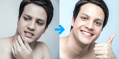 Aknebehandlung gegen unreeine Haut und grosse Poren bei Jolie Kosmetik Basel